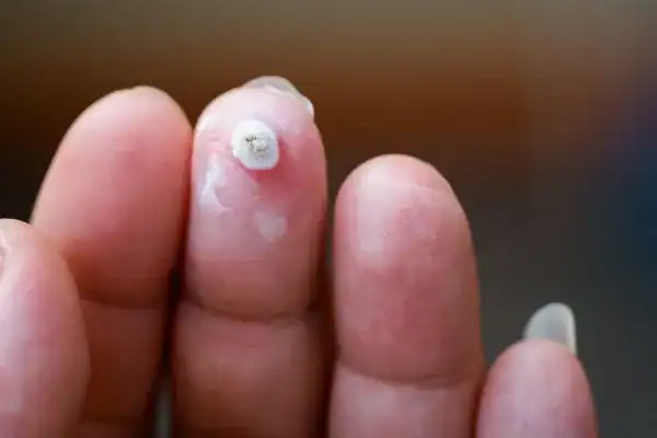 Image of white wart before cryopen treatment Rushden