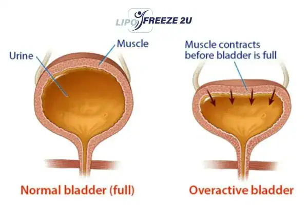 diagram of overactive bladder treatment Rushden