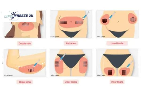 Benefits of Choosing Aqualyx for Fat Reduction Rushden