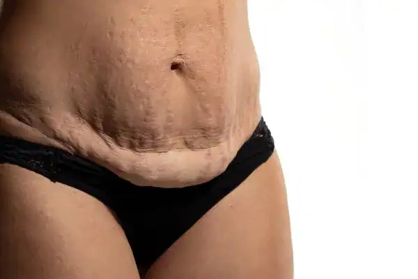 loose skin after weight loss injections Rushden