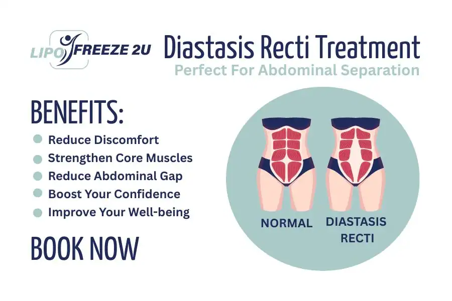 How Long Will It Take to See Improvements in Diastasis Recti Rushden