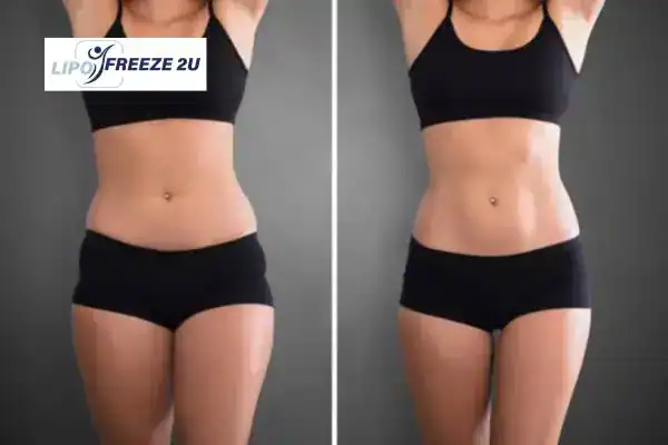 How Can LIPO FREEZE 2U Support Your Post-Pregnancy Body Recovery Rushden?
