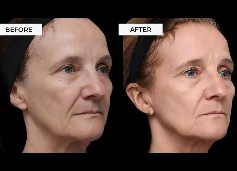 How Many RF Microneedling Sessions Will You Need to See a Difference Rushden?