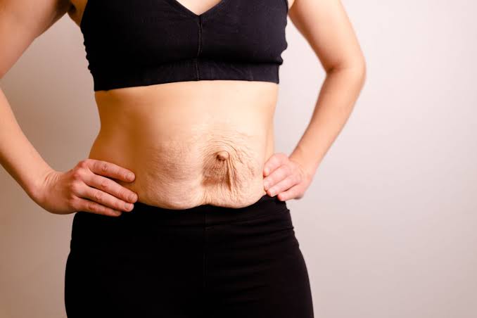 Is Surgery Really the Only Way to Repair Diastasis Recti Rushden?