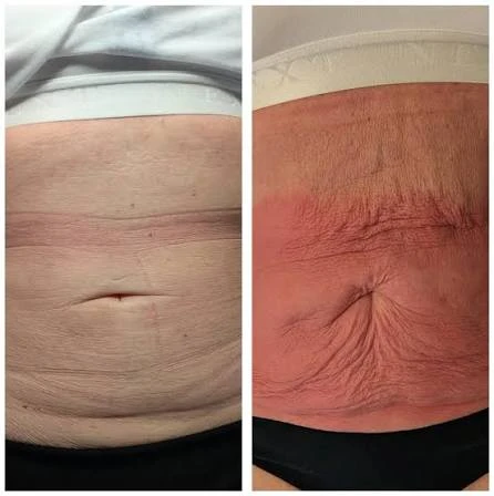 How Does RF Microneedling Improve Crepey, Thin and Uneven Skin Texture Rushden?