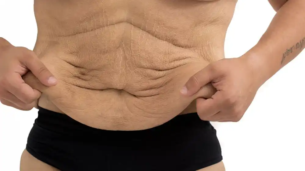 RF Microneedling for Loose Skin: How Can It Help Tighten and Reshape the Skin Rushden?